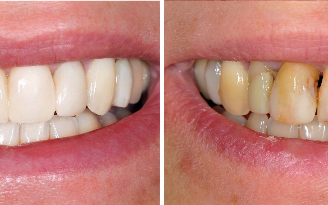 Full Mouth Rehabilitation: Transform Your Smile and Boost Your Confidence