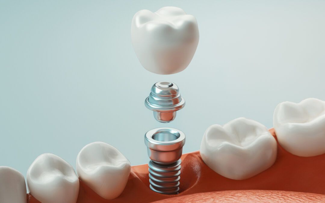 Dental Implants: A Comprehensive Guide for Patients