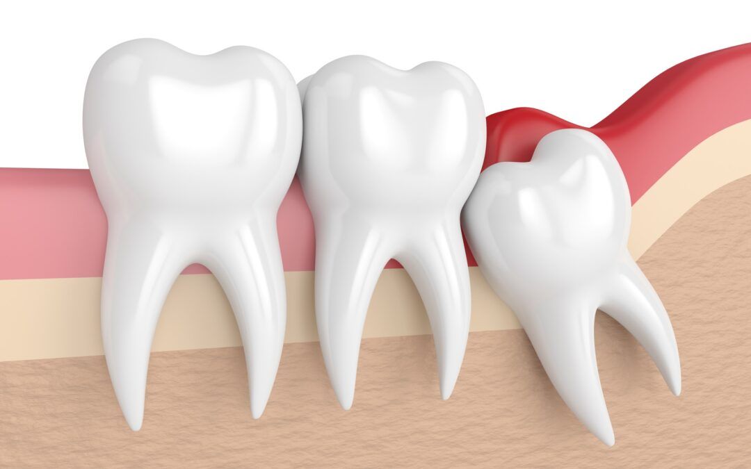 Wisdom Teeth Explained: Myths, Facts, and FAQs