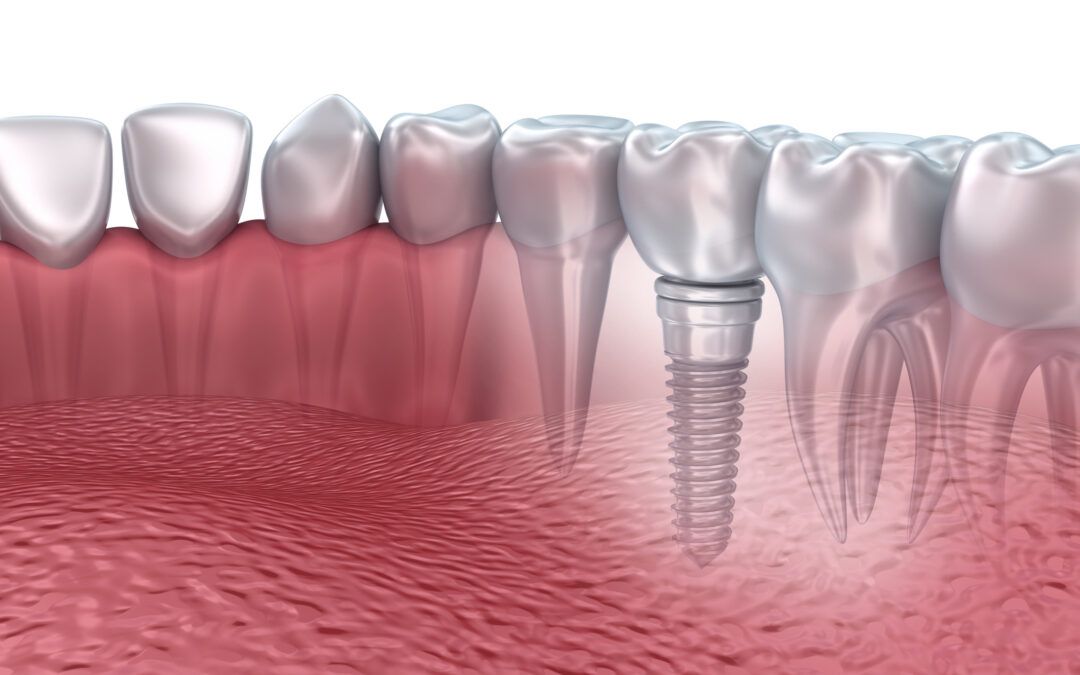 Restore Your Smile with Dental Implants at Queen Street Dental