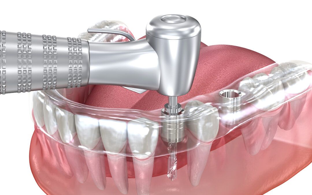 Restoring Oral Health Through Professional Surgery