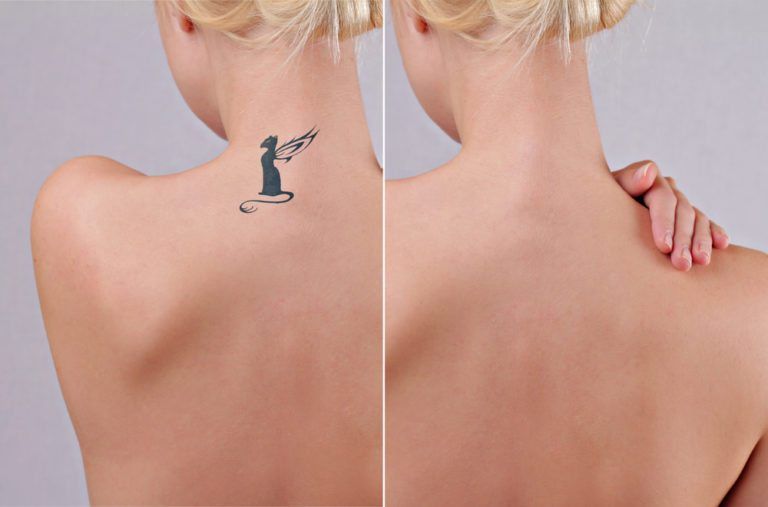 All Your Tattoo Removal Questions Answered  RealSelf