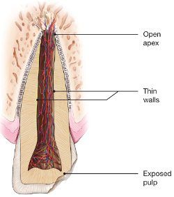 diagram of a chipped tooth