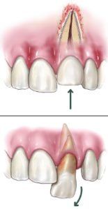 diagram of a dislodged tooth