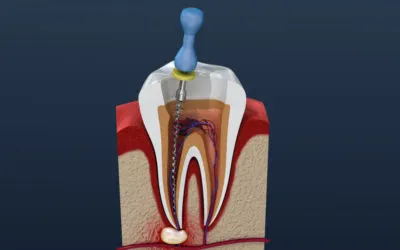Root Canals