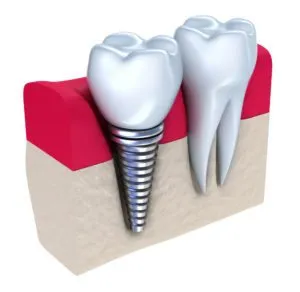 diagram of dental implants