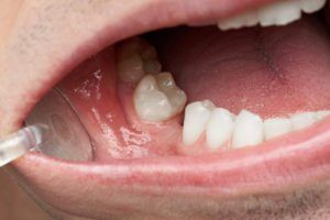 Close up image of teeth with dental checkup