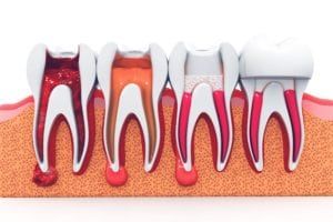 Stages of root canal