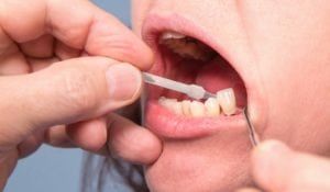 dental implant check up