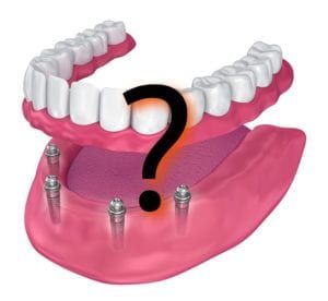 Dental Implant image