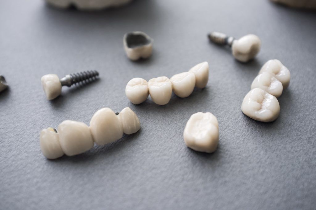 Dental restorations: implants, crowns, bridges