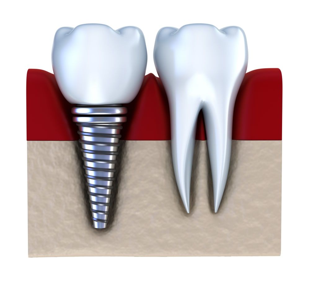 Dental implant next to a natural tooth to show similarity in structure and appearance 