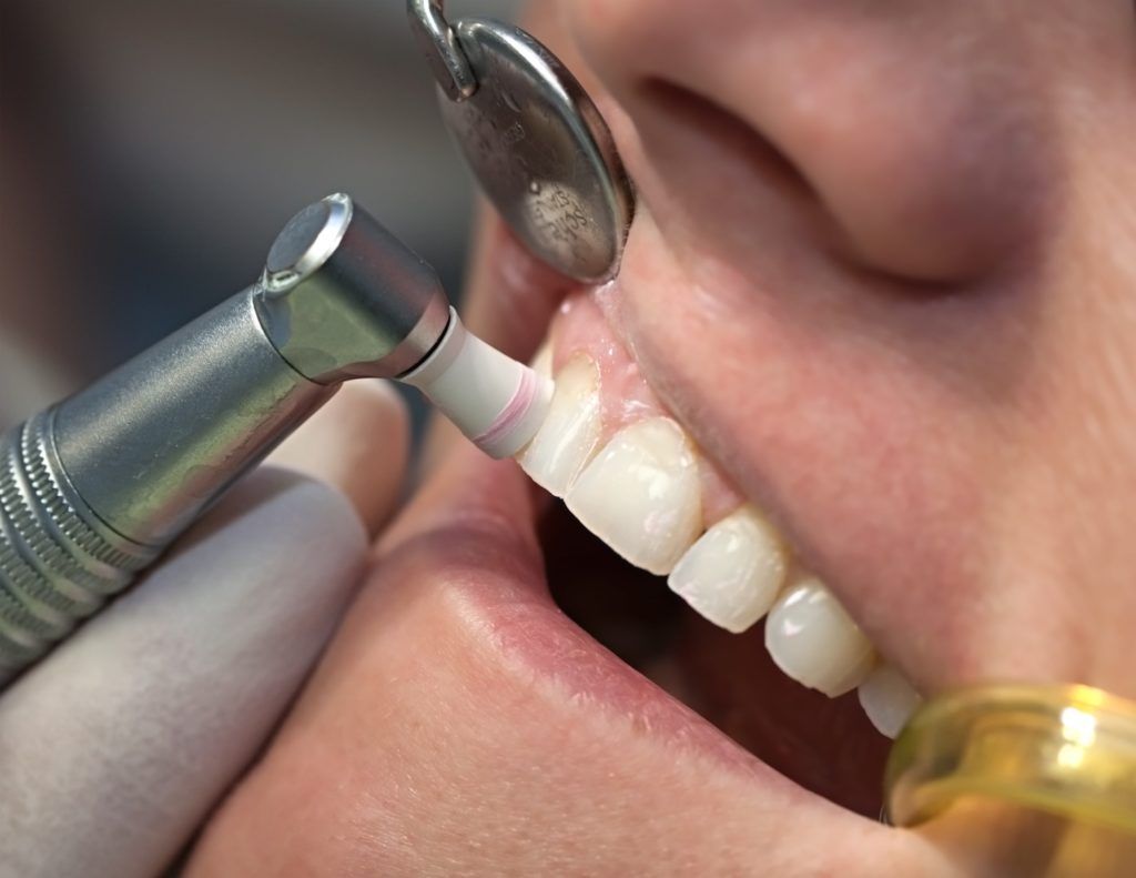 Closeup of a man having his teeth polished and cleaned
