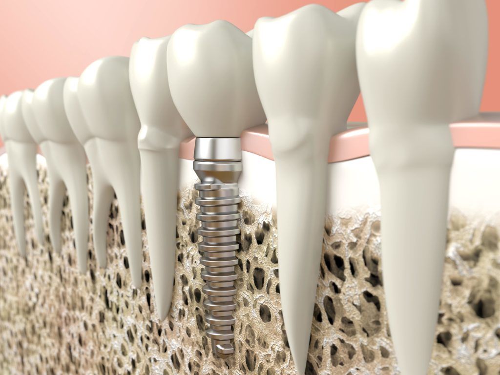 Endosteal Implant shown in the jawbone