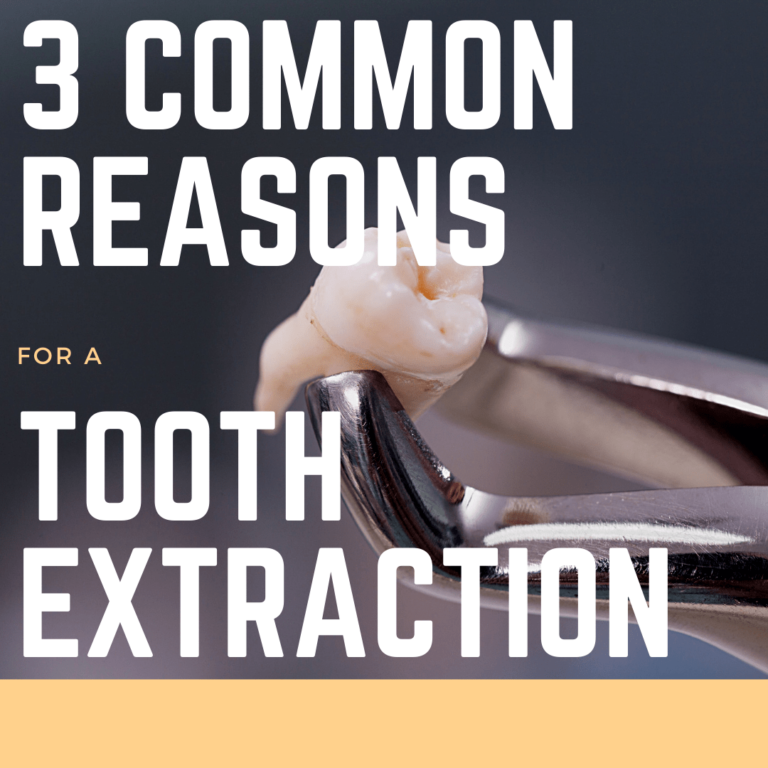 3 Common reasons for a tooth extraction