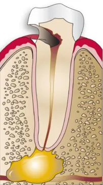 Tooth with severe decay and root abscess