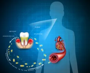 Explanation of Periodontal disease in human body