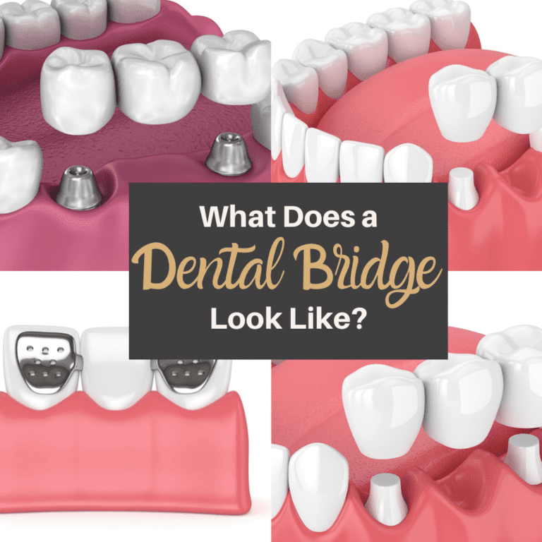 What Does a Dental Bridge Look Like