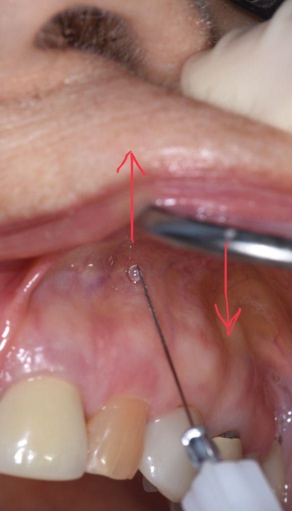 Dental School teaches to never bend an anesthetic needle