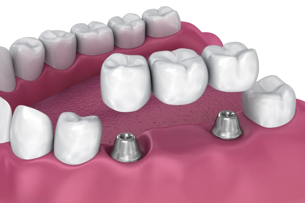 Implant-Supported Bridge