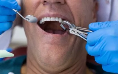 When Tooth Extractions are Necessary
