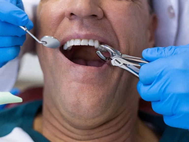 Teeth Extractions