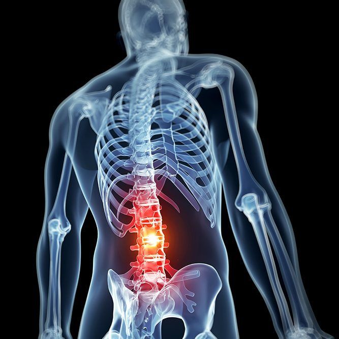 Lumbar Radiofrequency Ablation