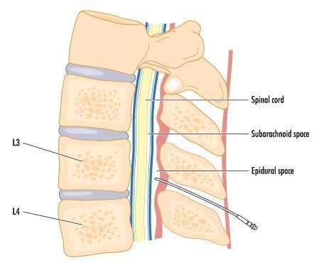 Lumbar Transforaminal Epidural Steroid Injection