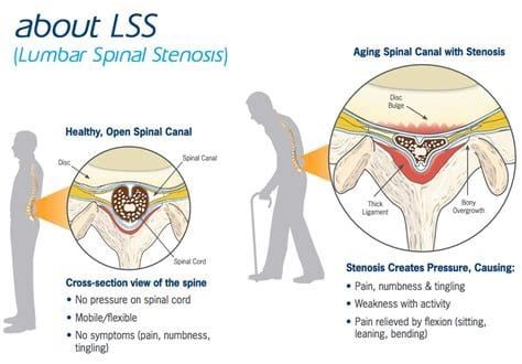 Spinal Stenosis, a Disease of Constriction & Compression