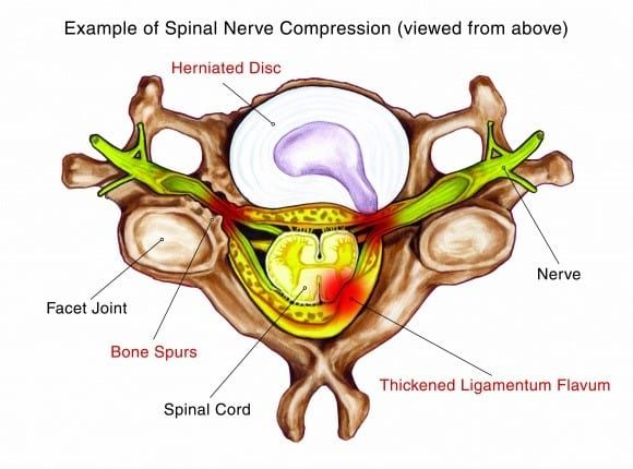 What is Lumbar Spinal Stenosis (LSS)?