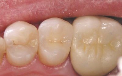 Composite Tooth-Colored Restorations