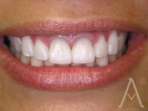 crown replacements after