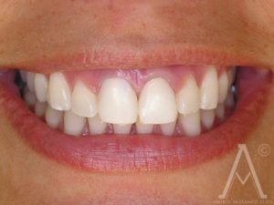 crown replacements before