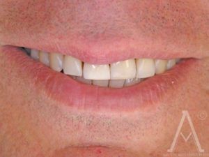 smile recontouring after