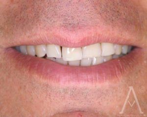 smile recontouring before