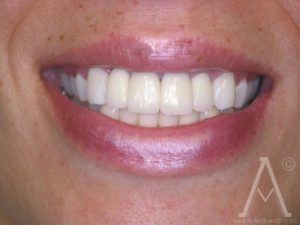 crown replacements after