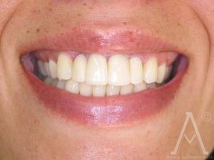 crown replacements before