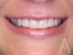 crown replacements after