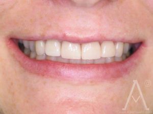 crown replacements before