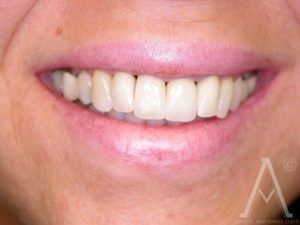 crown replacements after