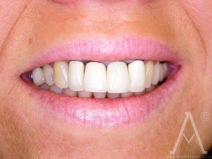 crown replacements before