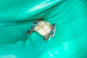 Green dental dam around tooth