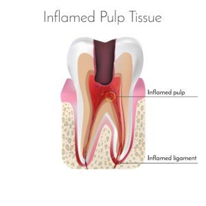 Computerized image of a tooth with infected pulp