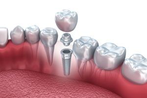 dental implant placement