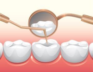 Dental tools inside mouth checking teeth