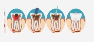 Computerized image showing the sequence of a root canal