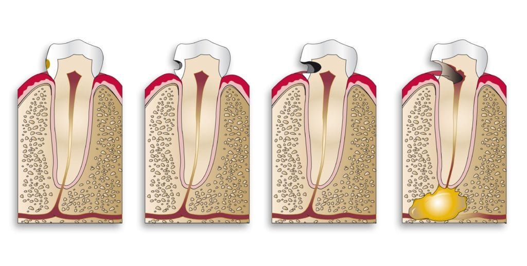 Diagram showing cavity progression