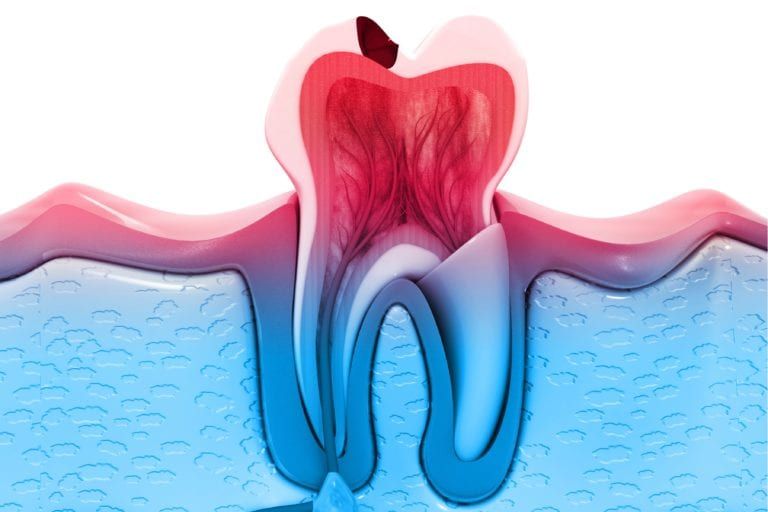 Tooth with cavity