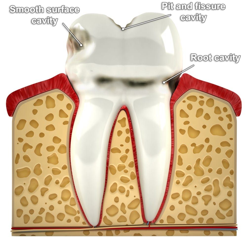 Diagram showing the different types of cavities