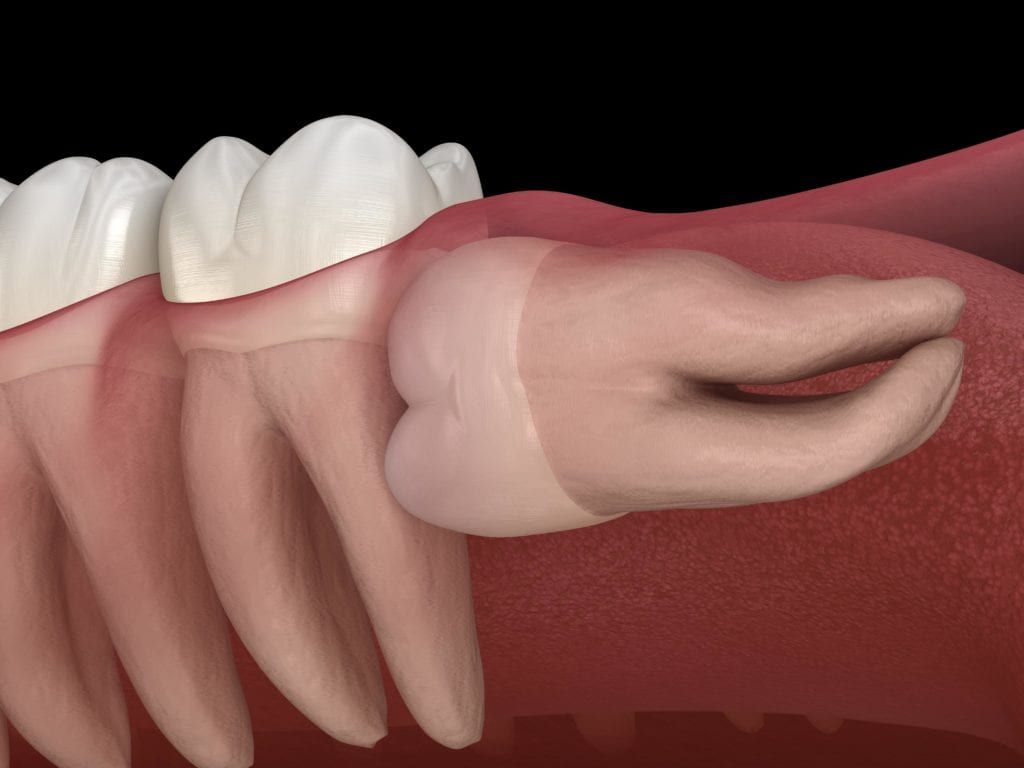 Horizontally impacted wisdom tooth